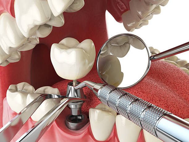Best Cracked Tooth Emergency Dentist  in Dunkirk, IN